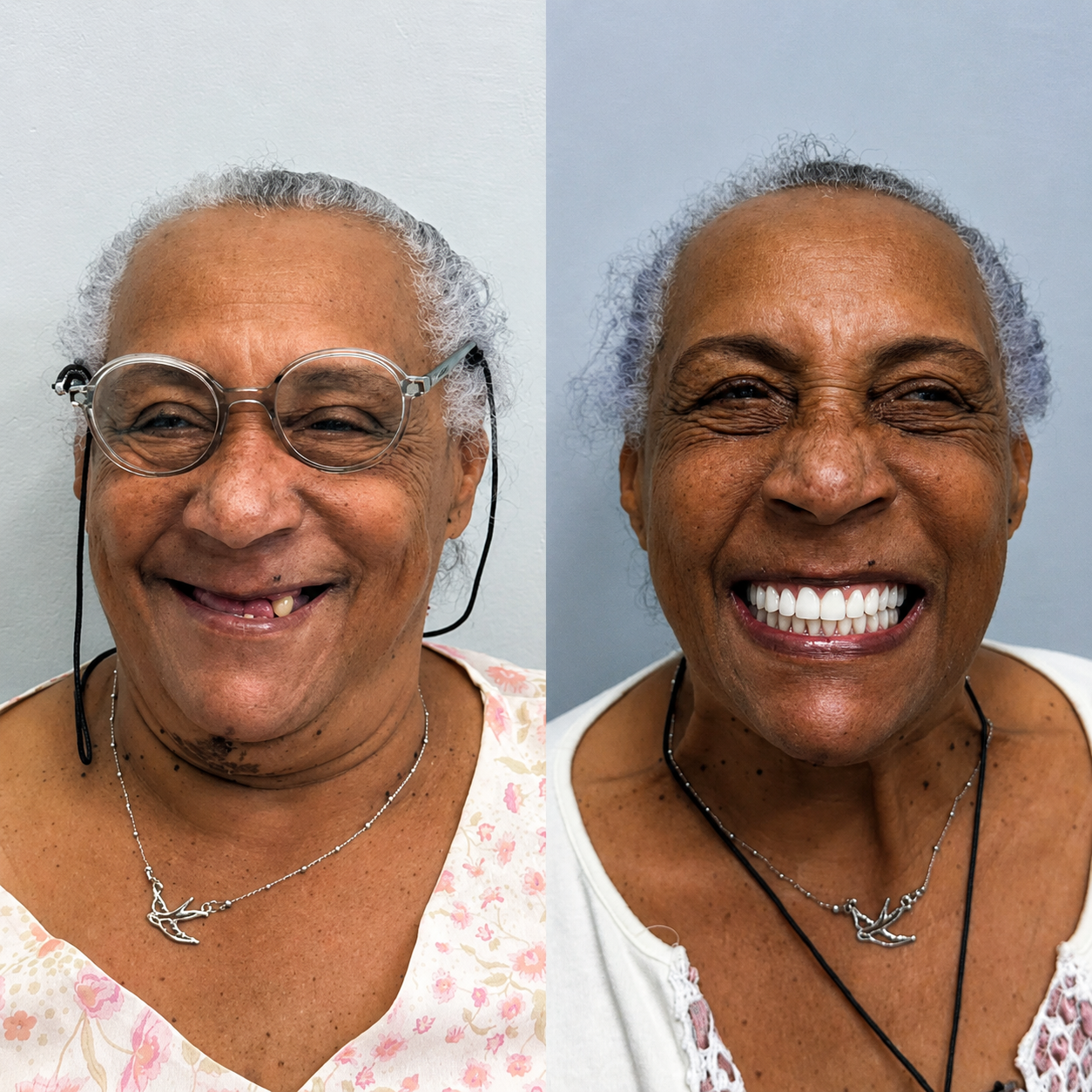 Caso clínico real: reabilitação do sorriso, antes e depois