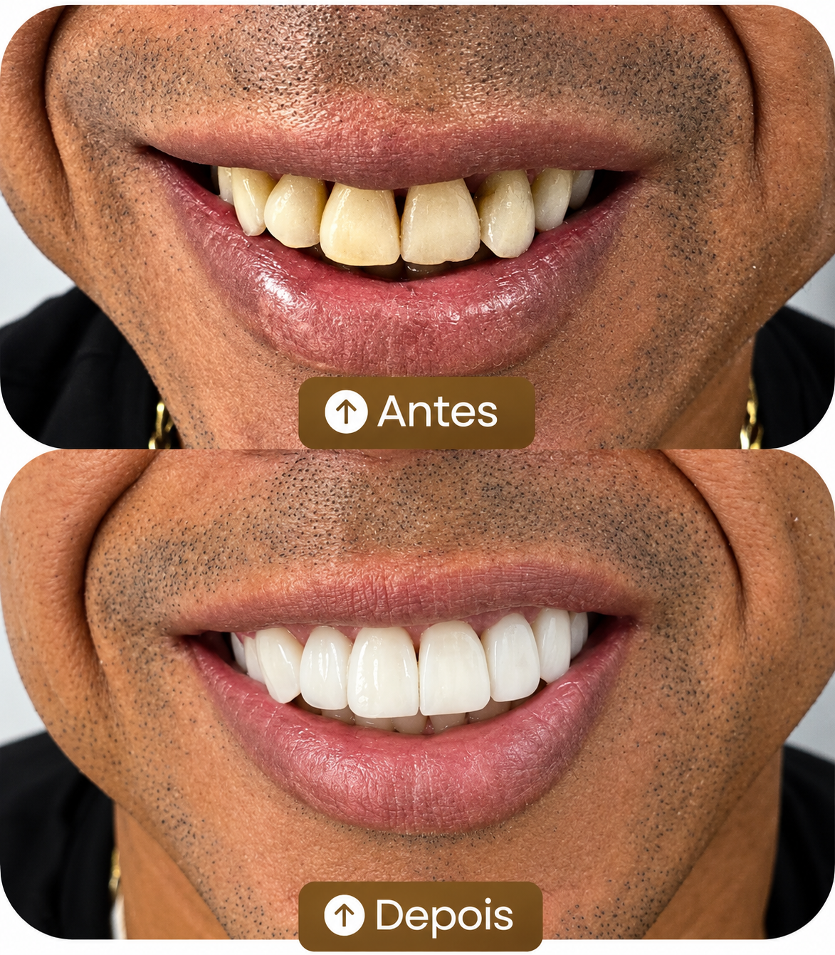 Caso clínico real: antes e depois do tratamento estético dos dentes